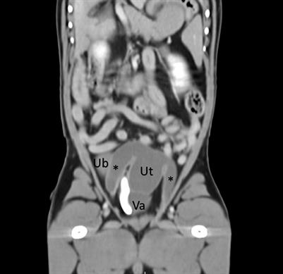 Case report: Persistent Müllerian duct syndrome and enlarged prostatic utricle in a male dog